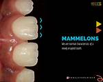 Mamelons Teeth