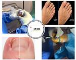 Managing Ingrown Toenails