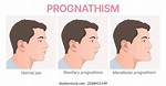 Mandibular Prognathism