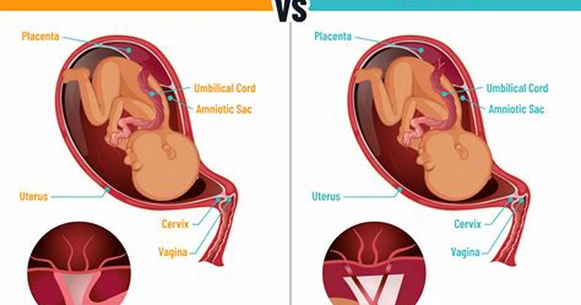 Marginal Cord Insertion Risks