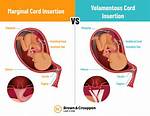 Marginal Cord Insertion Risks