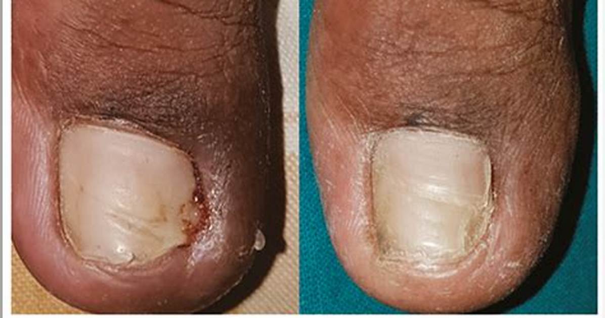 Matricectomy