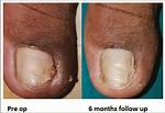 Matricectomy