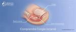 Matrixectomy