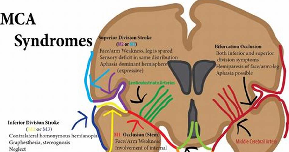 Mca Infarct