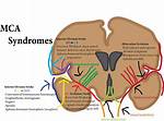 Mca Infarct