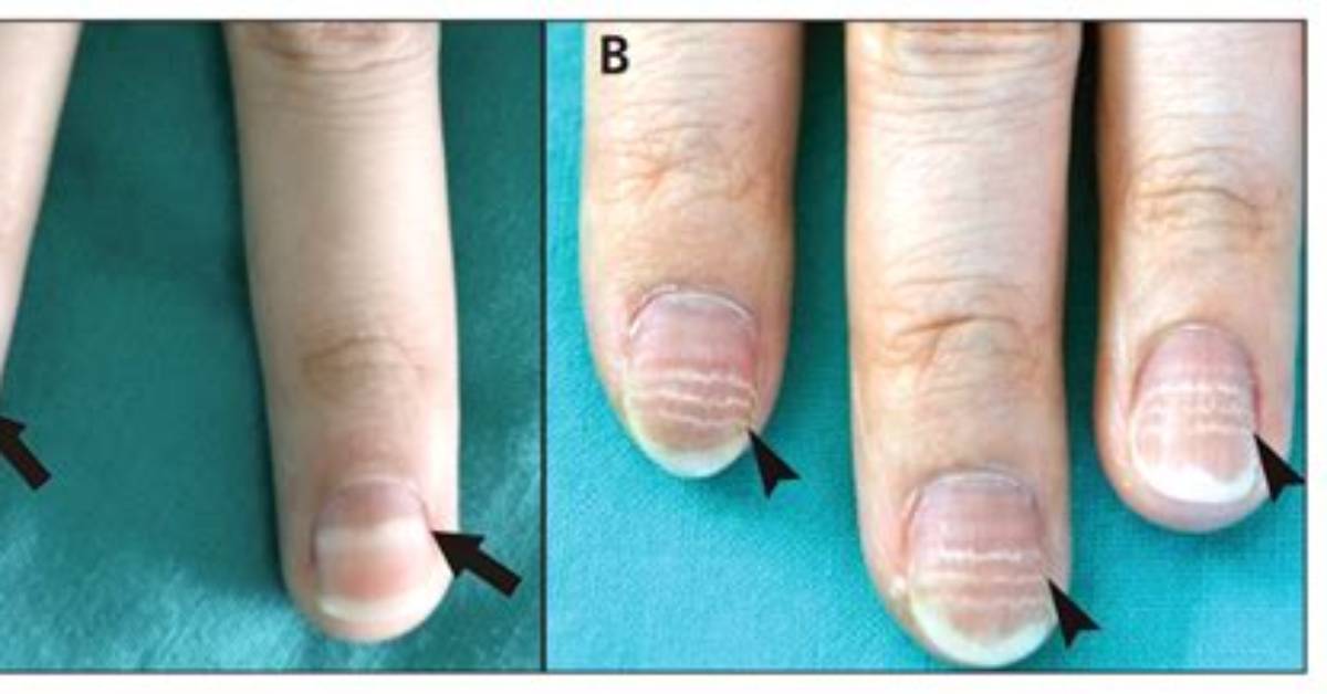 Mees Lines Nails