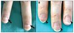 Mees Lines Nails