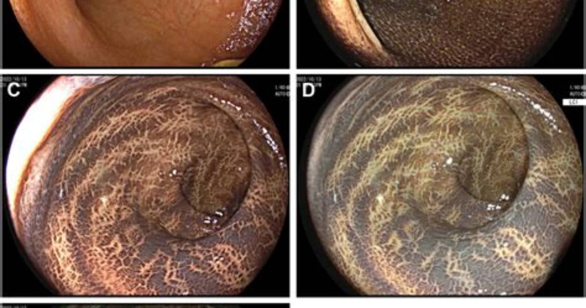 Melanosis