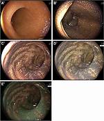 Melanosis
