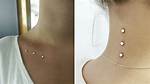 Microdermal