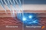 Microtrauma