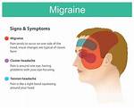Migraine for Example
