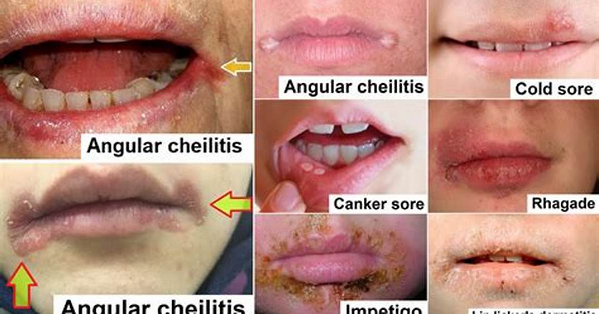 Mild Angular Cheilitis