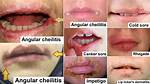 Mild Angular Cheilitis
