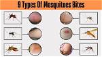 Mosquito Bite Symptom