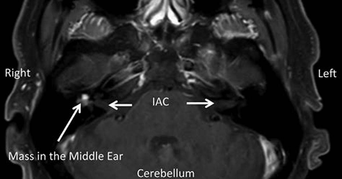 Mri Iac