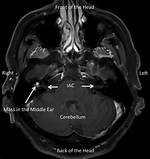Mri Iac