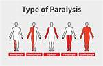 Myoparesis