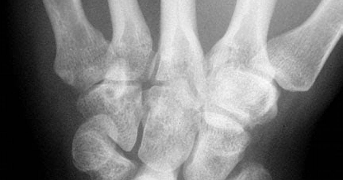 Negative Ulnar Variance