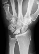 Negative Ulnar Variance