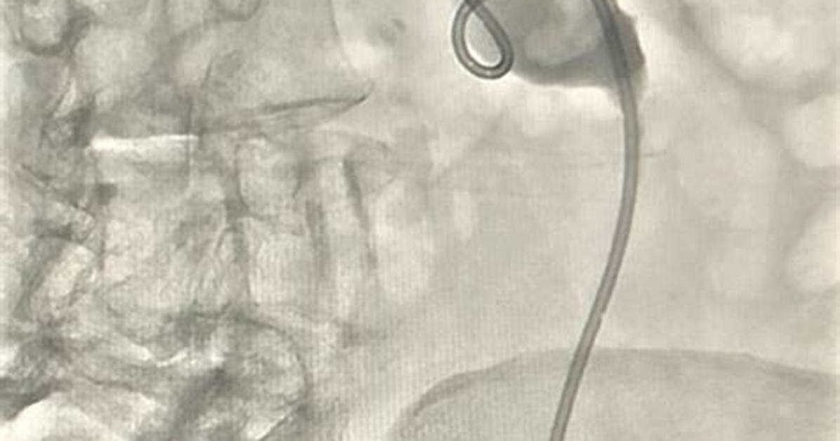 Nephrostogram