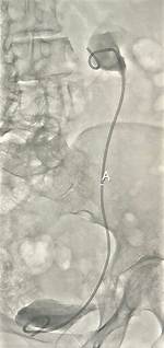 Nephrostogram