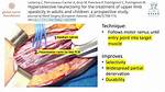 Neurectomy