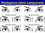 Nystagmus Testing