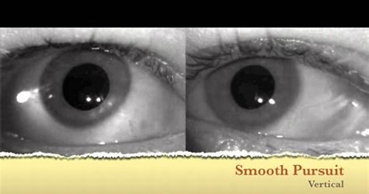 Ocular Flutter