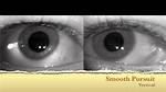 Ocular Flutter