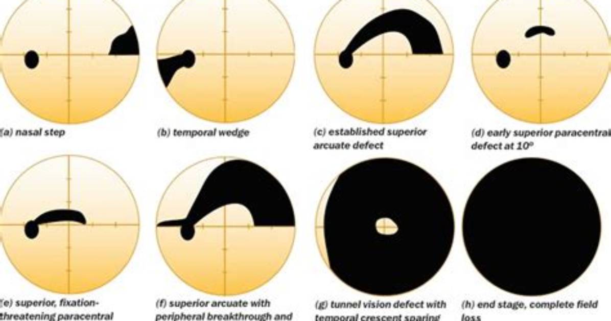 On Visual Field Defect?