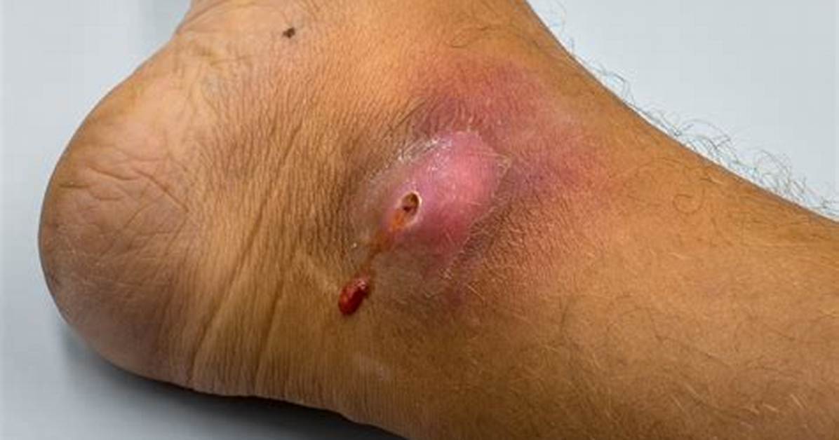 Oozing Wound