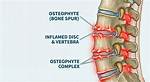 Osteophyte Complex