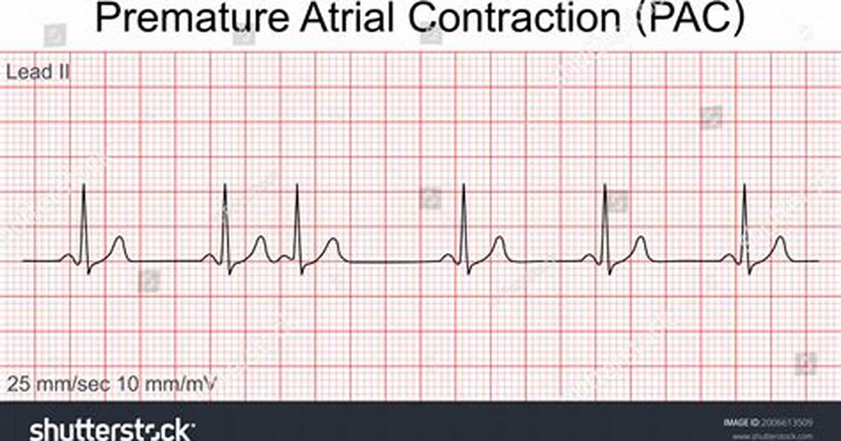 Pac Ecg