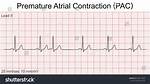 Pac Ecg