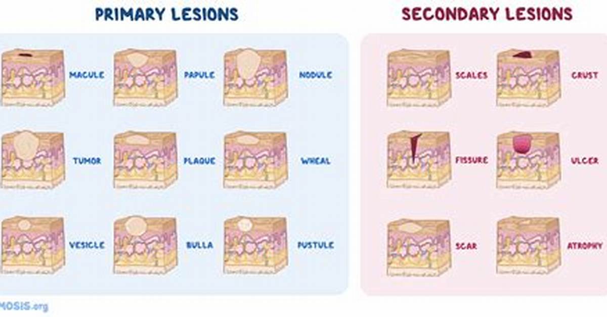 Papule vs Macule