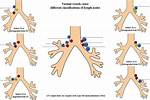 Paratracheal Lymph Node
