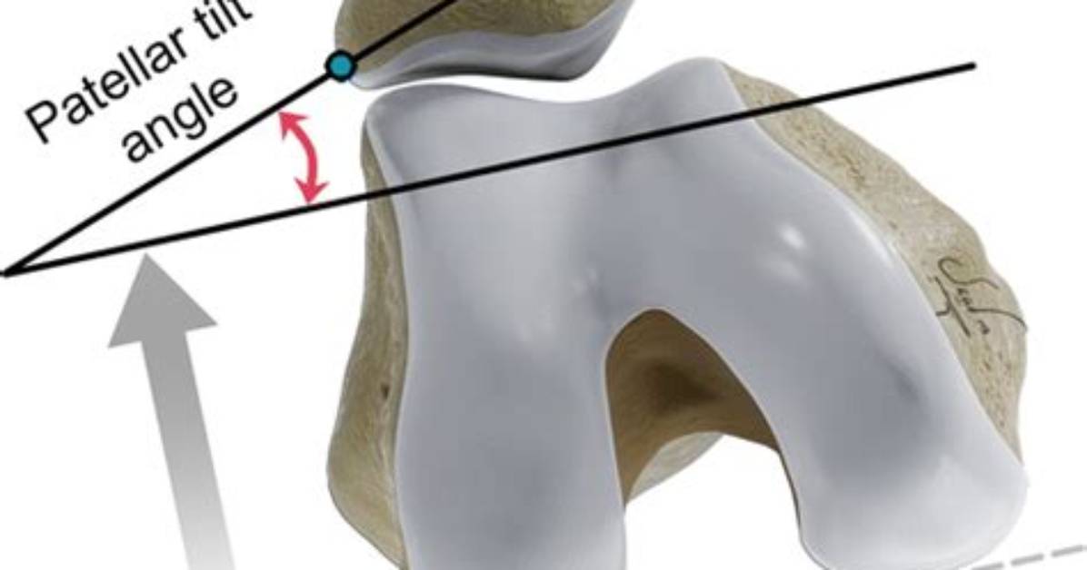 Patellar Tilt