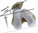 Patellar Tilt