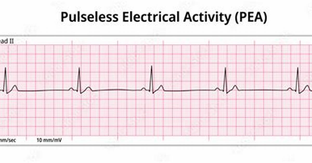 Pea Ecg