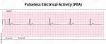 Pea Ecg