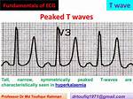 Peaked T Wave