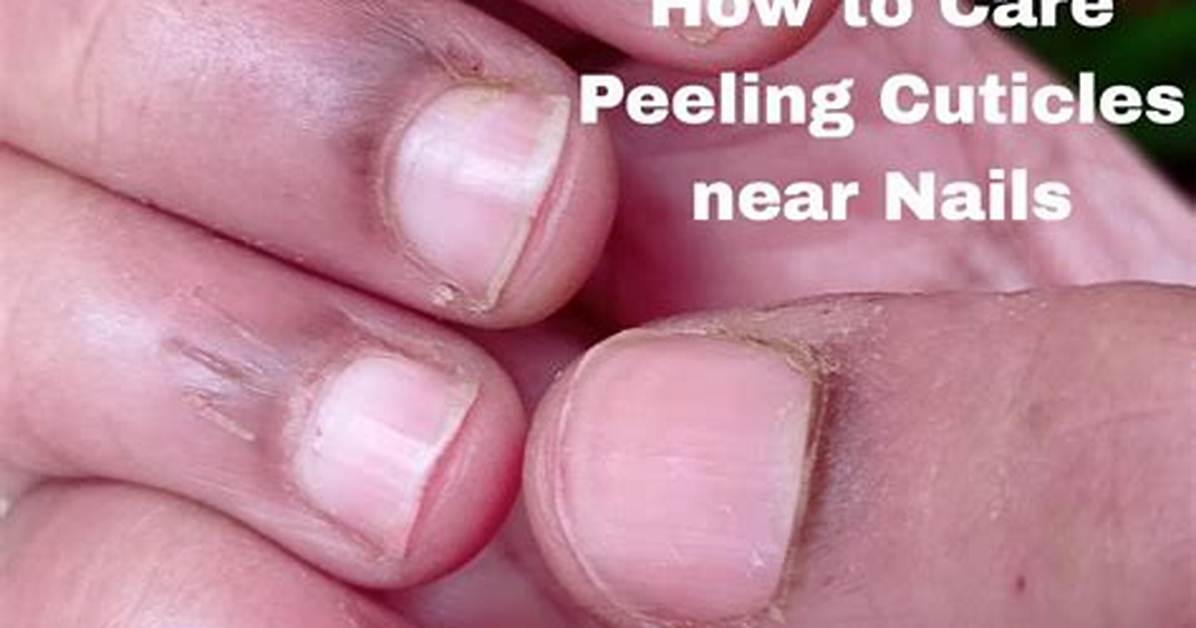 Peeling Cuticles