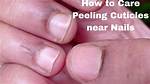 Peeling Cuticles