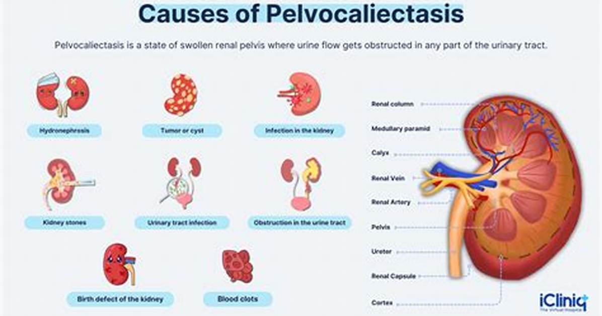 Pelvicaliectasis