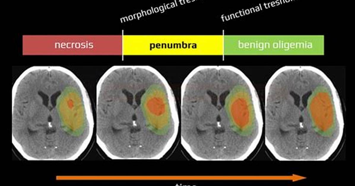 Penumbra Brain