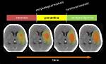Penumbra Brain