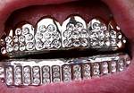 Permanent Diamond Teeth