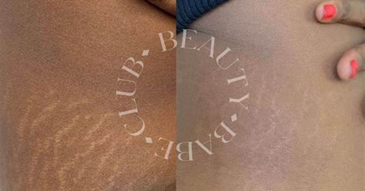 Permanent Mark After Surgery